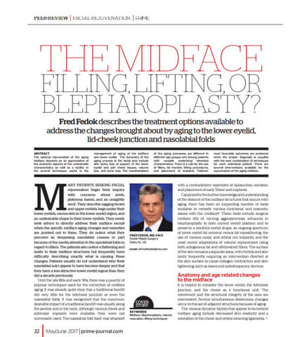 Publications: The Midface filling lifting or blepharoplasty?