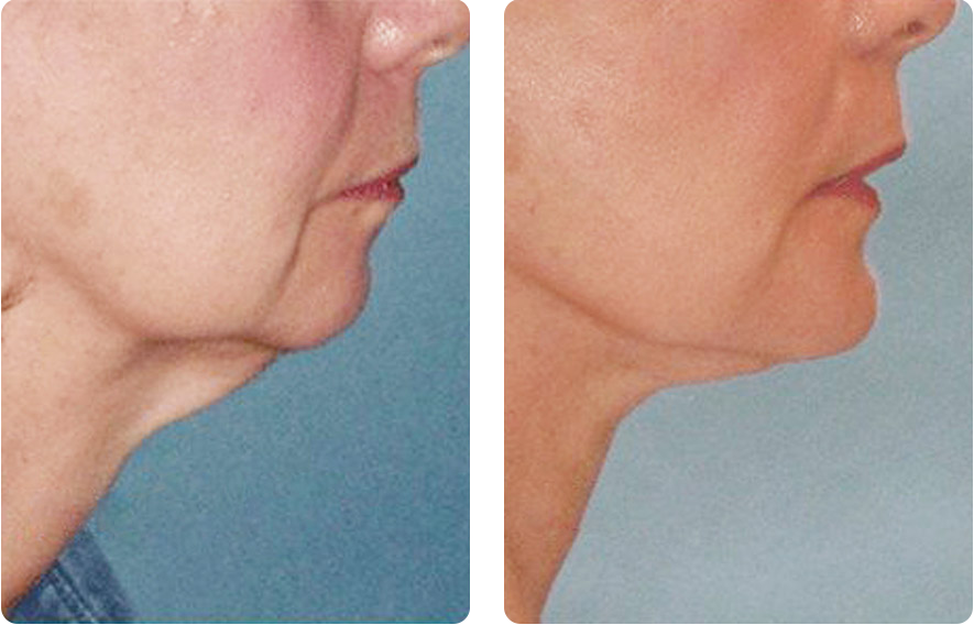 Woman’s face before and after - Double Chin Removal treatment, r-side view, patient 1