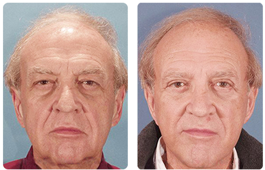 Male face before and after - Facelift treatment, front view, patient 6