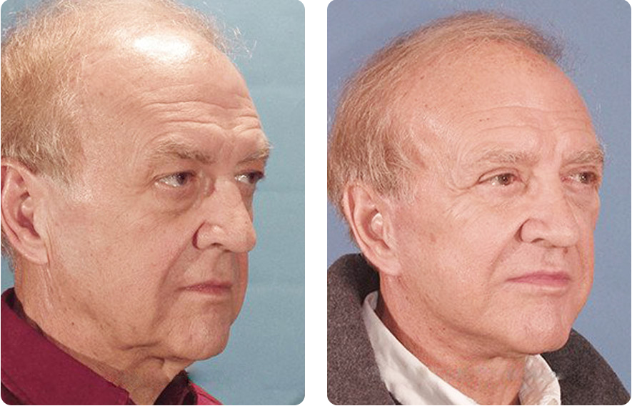 Male face before and after - Facelift treatment, r-side oblique view, patient 6