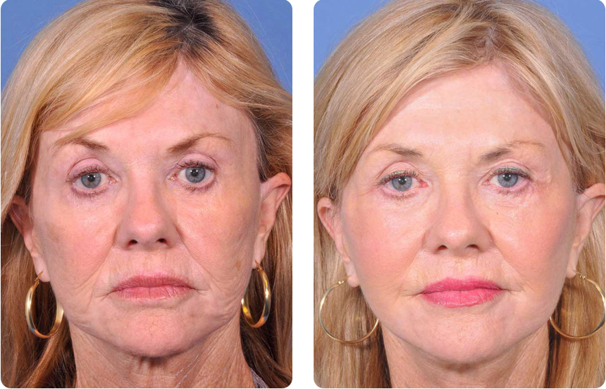 Woman’s face before and after - Facelift treatment, front view, patient 1