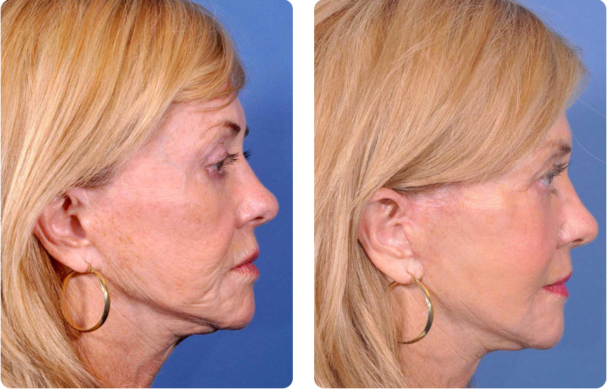 Woman’s face before and after - Facelift treatment, r-side view, patient 1