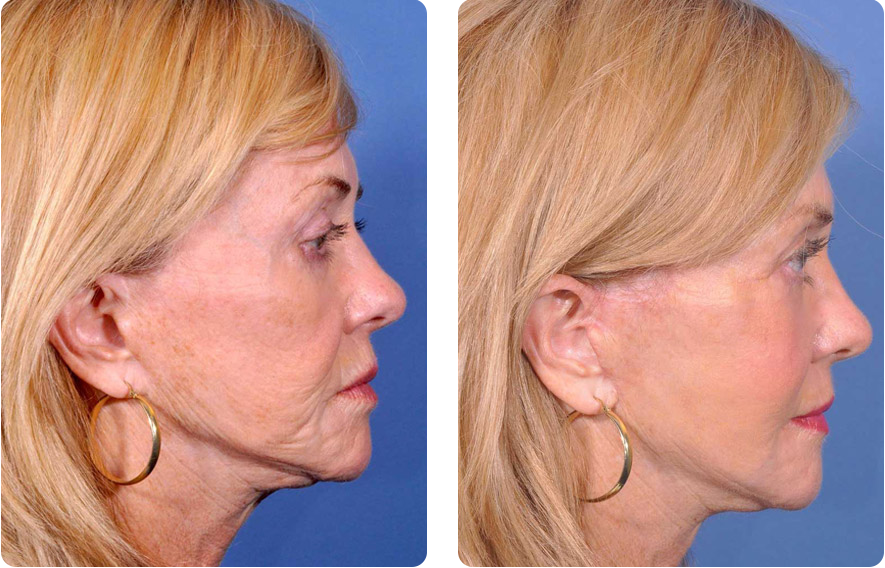 Jowls Foley Restore Jawline Definition
