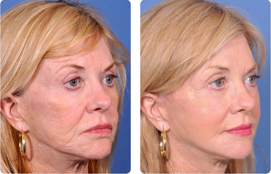 Woman’s face before and after - Facelift treatment, r-side oblique view, patient 1