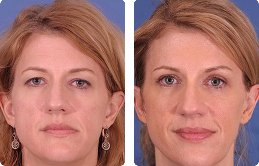 Woman’s face before and after - Upper Lid Blepharoplasty And Brow Lift treatment, front view, patient 1