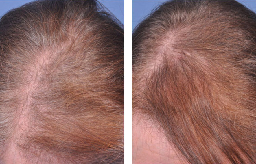 Woman’s head hair before and after Platelet-Rich Plasma (PRP) treatment, front view, patient 2