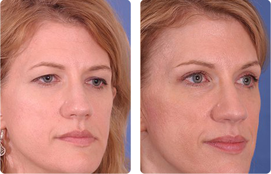Woman’s face before and after - Upper Lid Blepharoplasty And Brow Lift treatment, oblique view, patient 1