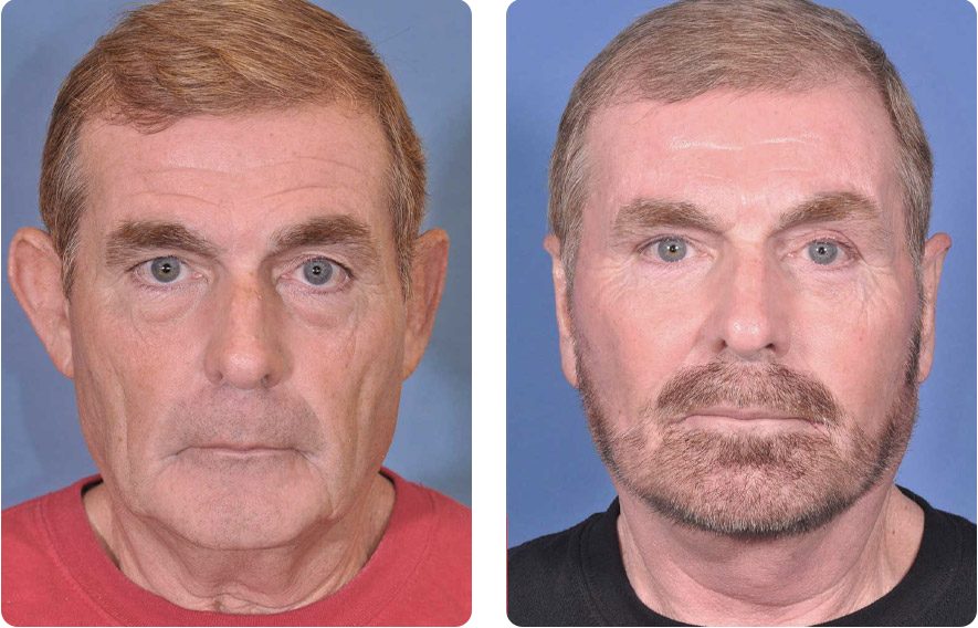 Male face before and after - Facelift and Ear Pin Back (Otoplasty) treatments, front view, patient 4