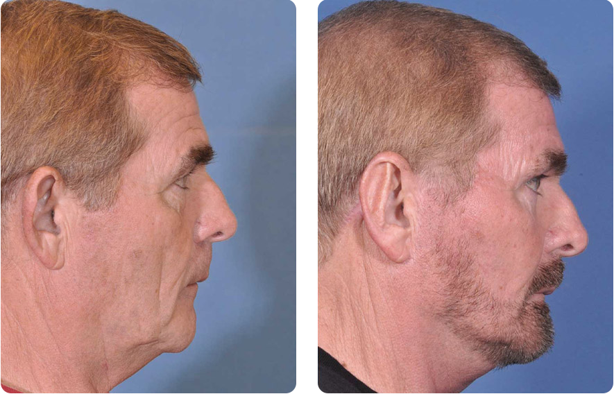 Male face before and after - Facelift treatment, r-side view, patient 2