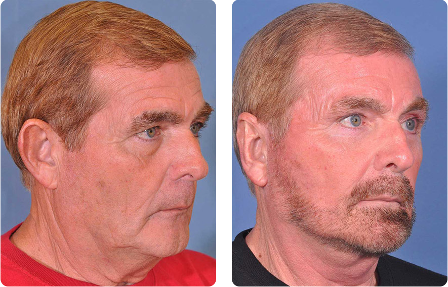 Male face before and after - Facelift treatment, r-side oblique view, patient 2
