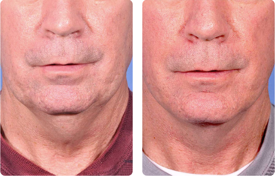 Male face before and after - Facelift treatment, front view, patient 3
