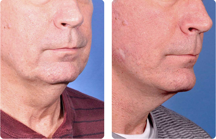 Chin Augmentation Before & After Results