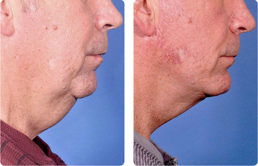 Male face before and after - Facelift treatment, r-side view, patient 3