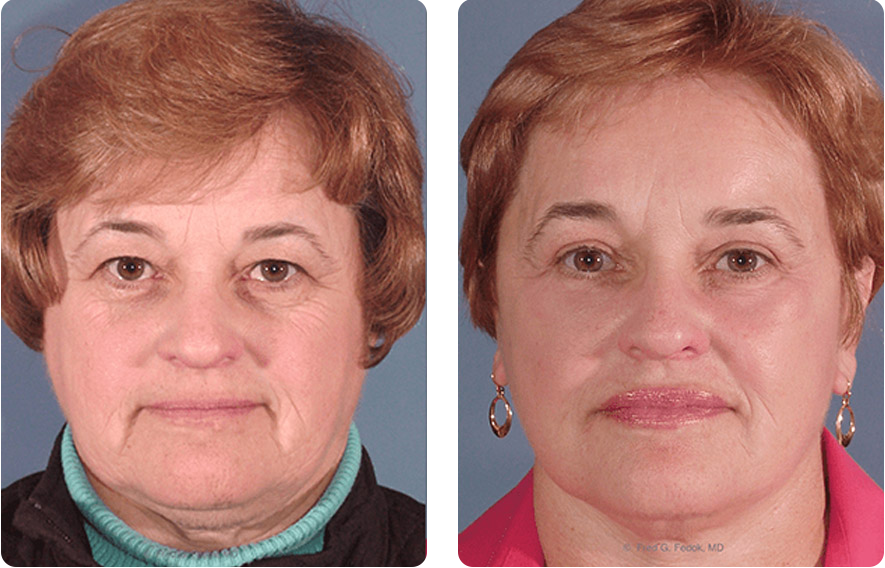 Woman’s face before and after - Facelift treatment, front view, patient 7