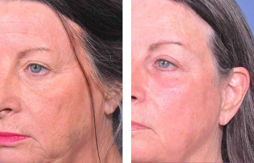 Woman’s face before and after - Lasers & Energy Based Devices treatment, l-side oblique view