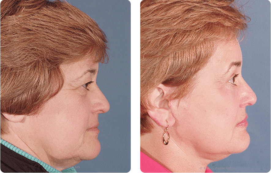 Woman’s face before and after - Facelift treatment, r-side view, patient 7