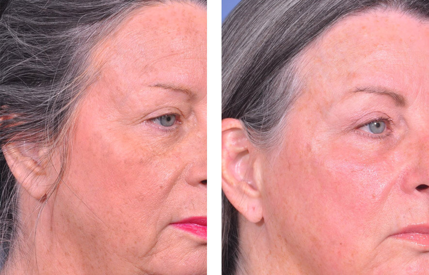 Woman’s face before and after - Lasers & Energy Based Devices treatment, r-side oblique view