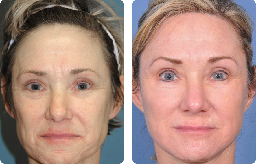 Woman’s face before and after - Facelift treatment, front view, patient 4