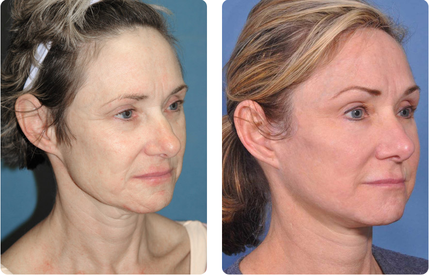 Woman’s face before and after - Facelift treatment, r-side oblique view, patient 4