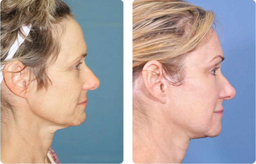 Woman’s face before and after - Facelift treatment, r-side view, patient 4