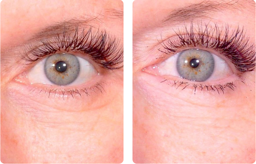 Woman’s eyelids before and after Platelet-Rich Plasma (PRP) treatment, front view, patient 1