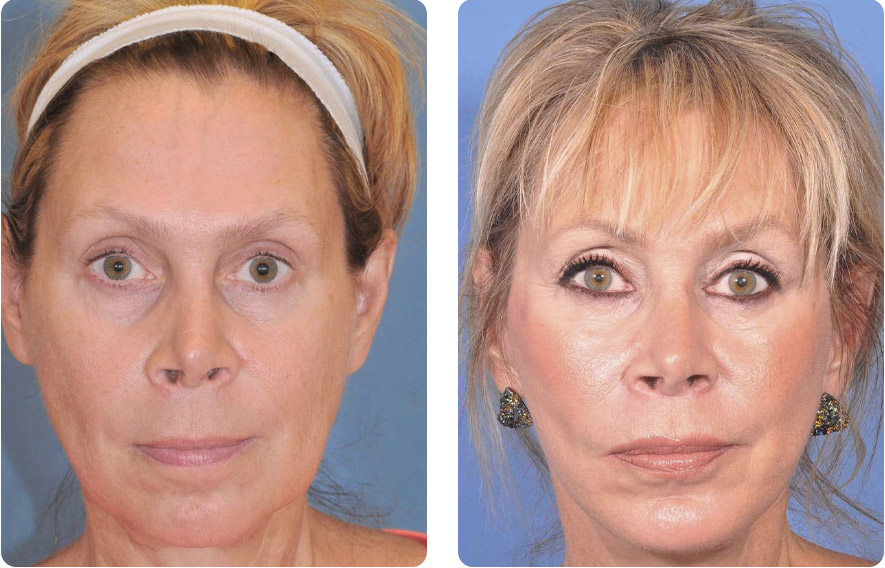 Woman’s face before and after - Facelift treatment, front view, patient 5