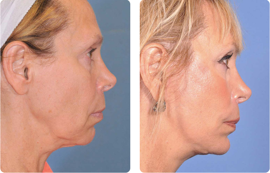 Woman’s face before and after - Facelift treatment, r-side view, patient 5