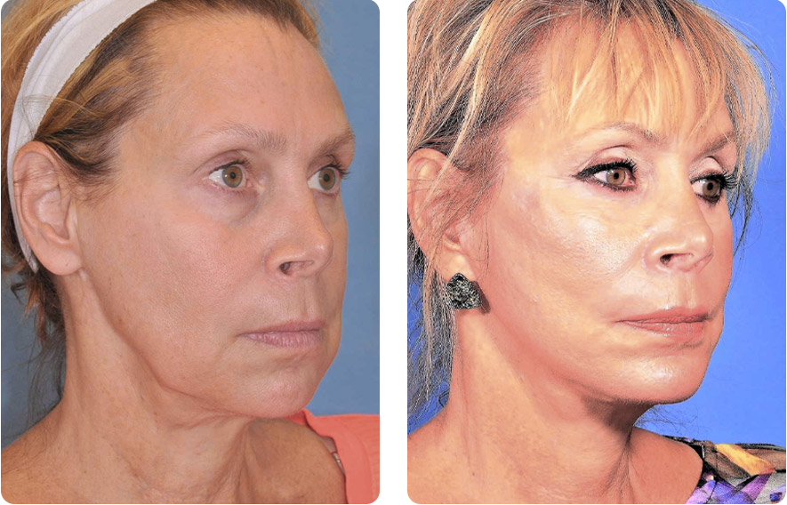 Woman’s face before and after - Facelift treatment, r-side oblique view, patient 5