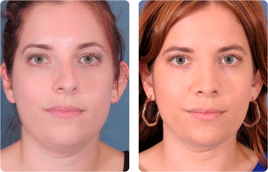 Woman’s face before and after - Rhinoplasty & Revision Rhinoplasty treatment, front view, patient 1