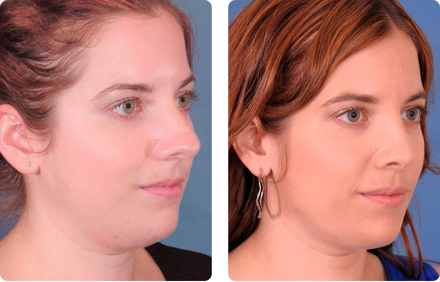 Woman’s face before and after - Rhinoplasty & Revision Rhinoplasty treatment, r-side oblique view, patient 1