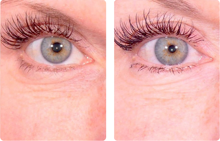 Woman’s eyelids, before and after Platelet-Rich Plasma (PRP) treatment, front view (right eye), patient 1