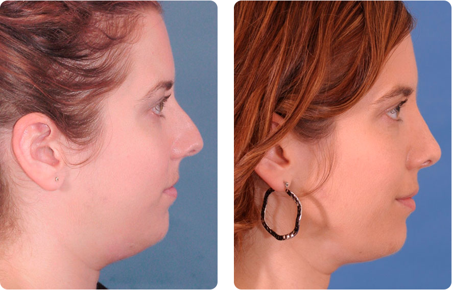 Woman’s face before and after - Rhinoplasty & Revision Rhinoplasty treatment, r-side view, patient 1