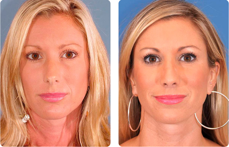 Woman’s face before and after - Rhinoplasty & Revision Rhinoplasty treatment, front view, patient 2