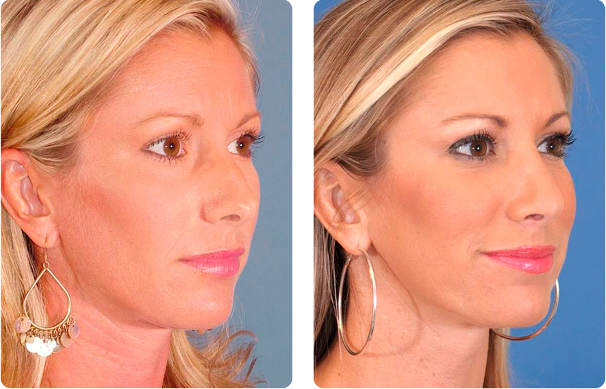 Woman’s face before and after - Rhinoplasty & Revision Rhinoplasty treatment, r-side oblique view, patient 2