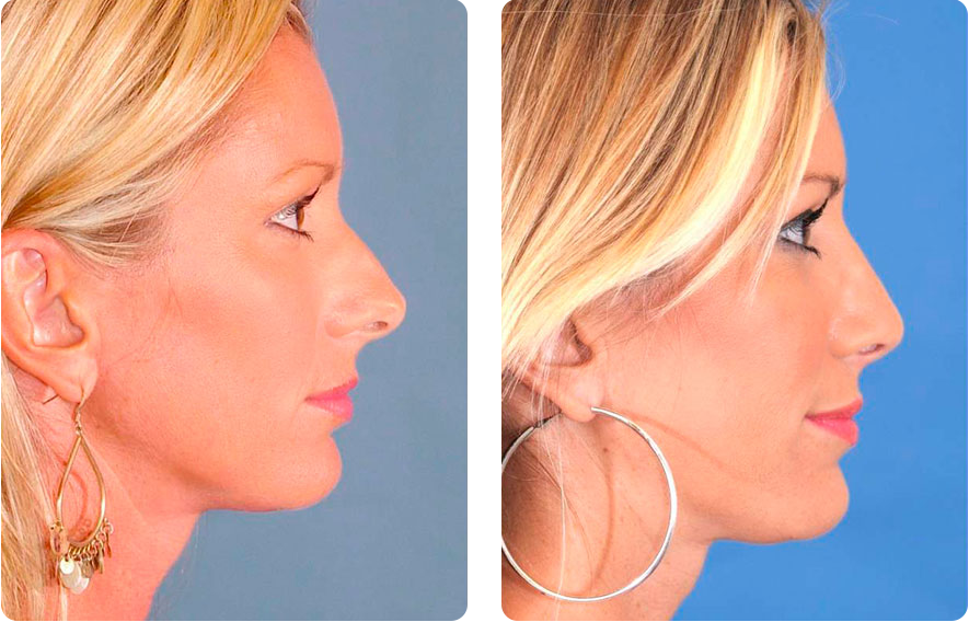 Woman’s face before and after - Rhinoplasty & Revision Rhinoplasty treatment, r-side view, patient 2
