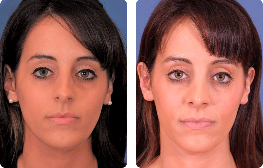Woman’s face before and after - Rhinoplasty & Revision Rhinoplasty treatment, front view, patient 3
