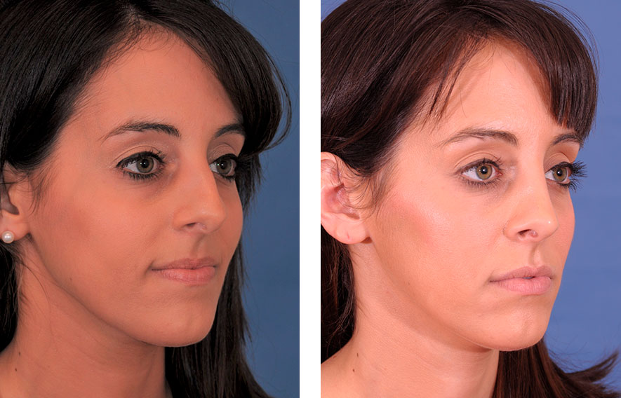 Woman’s face before and after - Rhinoplasty & Revision Rhinoplasty treatment, r-side oblique view, patient 3