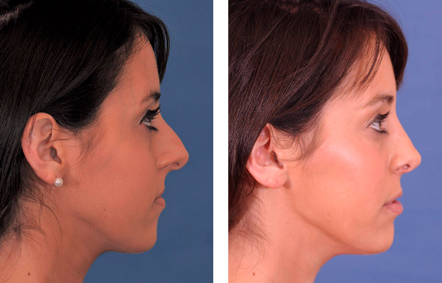 Woman’s face before and after - Rhinoplasty & Revision Rhinoplasty treatment, r-side view, patient 3