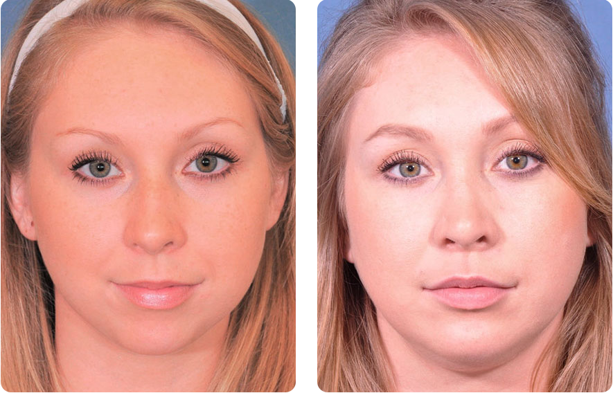 Woman’s face before and after - Rhinoplasty & Revision Rhinoplasty treatment, front view, patient 4