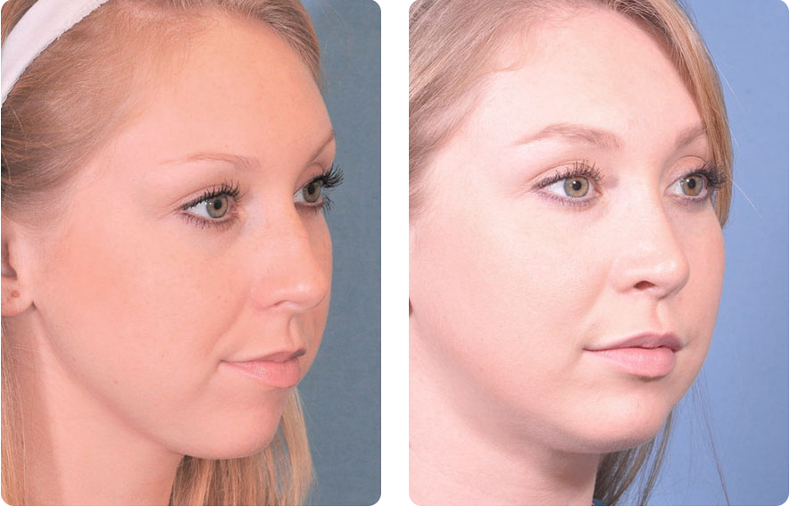 Woman’s face before and after - Rhinoplasty & Revision Rhinoplasty treatment, r-side oblique view, patient 4
