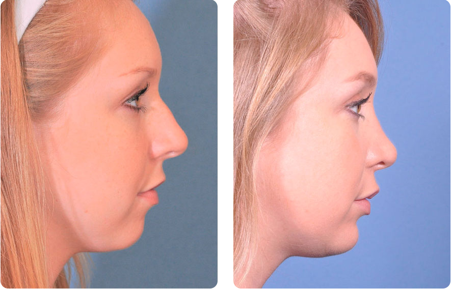 Woman’s face before and after - Rhinoplasty & Revision Rhinoplasty treatment, r-side view, patient 4