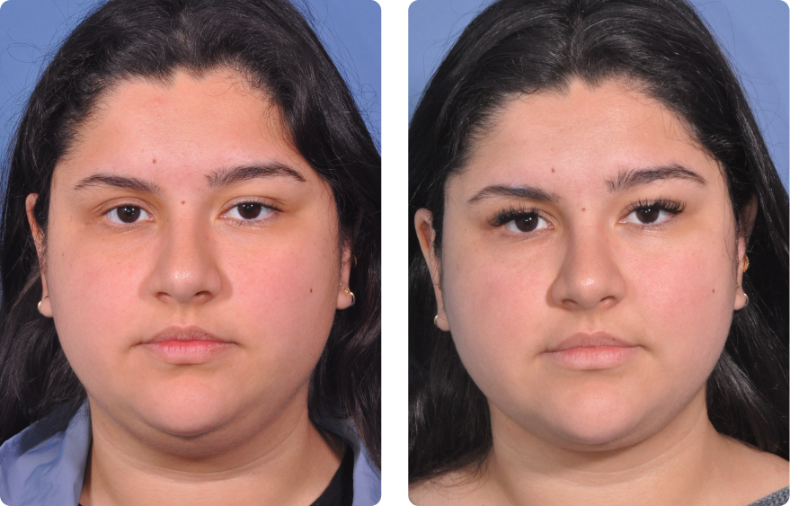 Woman’s face, before and after Evoke treatment, front view, patient 3