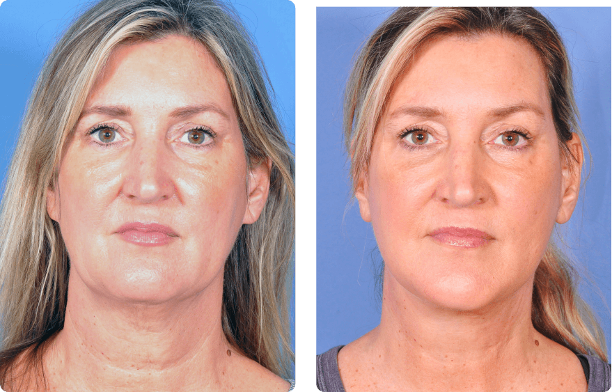 Woman’s face before and after - Chin augmentation treatment, front view, patient 6