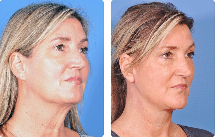 Woman’s face before and after - Chin augmentation treatment, oblique view, patient 6