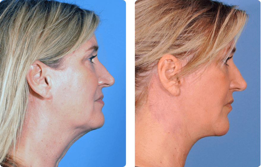 Woman’s face before and after - Chin augmentation treatment, r-side view, patient 6