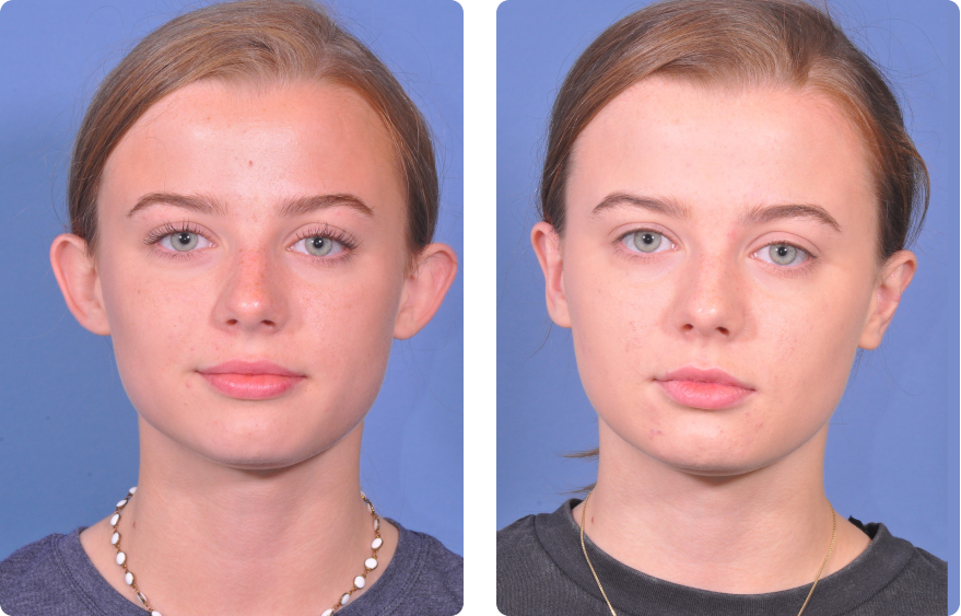 Young girl face, before and after Ear Pin Back (Otoplasty), front view, patient 2