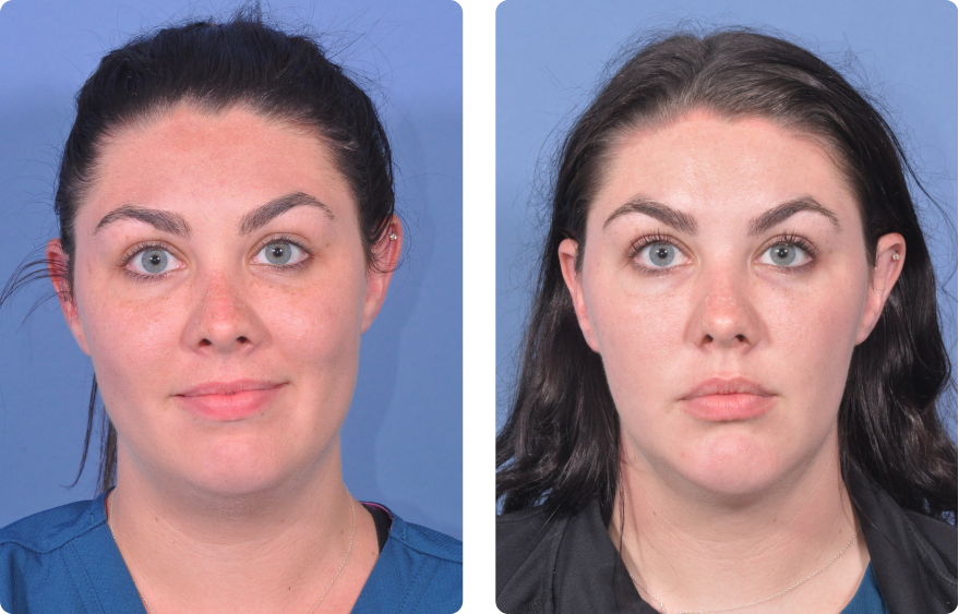 Facial Liposuction Before & After Results