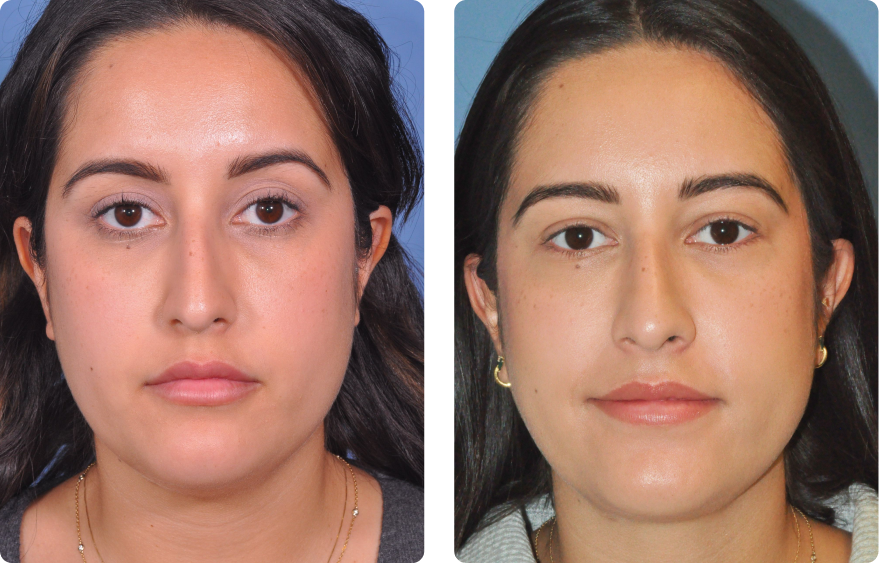 Woman’s face, before and after Evoke treatment, front view, patient 5