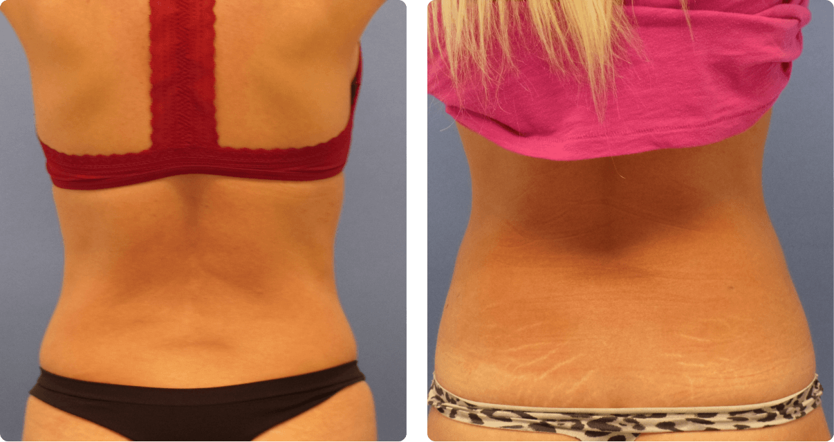 Woman’s body, before and after BeautiFill treatment, back view, patient 1