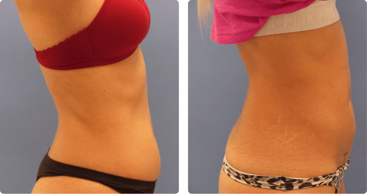Woman’s body, before and after BeautiFill treatment, r-side view, patient 1